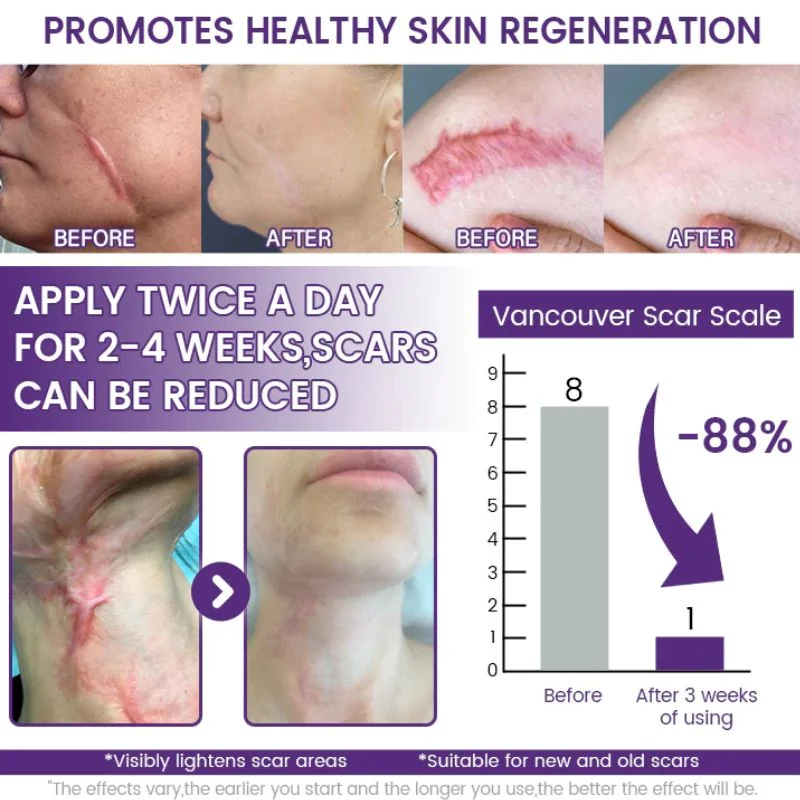 TIMILK Scarvanisher Scar Gel 30g | Advanced Scar & Stretch Marks Removal Cream | Fast-Absorbing Skin Repair Gel - Image 4
